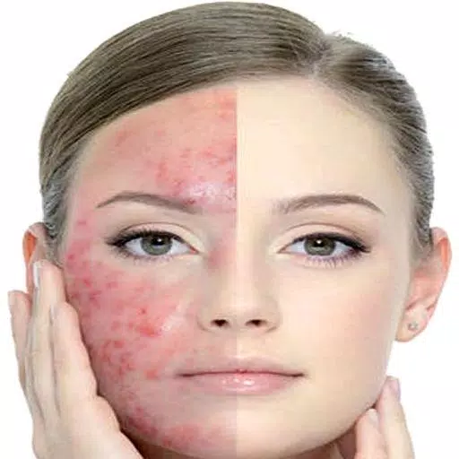 Get Rid of Acne  (Guide)應用截圖第1張